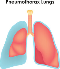 Pneumothorax Lungs Science Vector Illustration