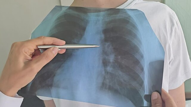 Doctor diagnoses patient's health condition for asthma, lung disease, COVID-19. Chest X-ray pneumonia - Powered by Adobe