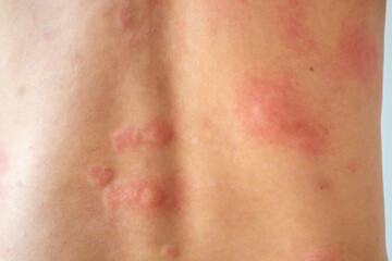 Fototapeta premium Young asian man itching and scratching on his back from allergic itchy dry skin eczema dermatitis insect bites