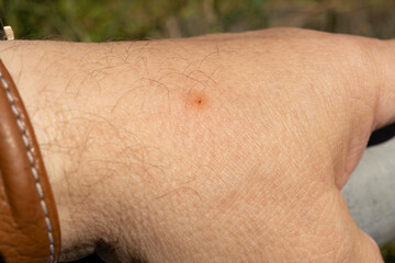 Female Common horse fly or Cleg fly (Haematopota pluvialis) bite wound on human hand skin close-up