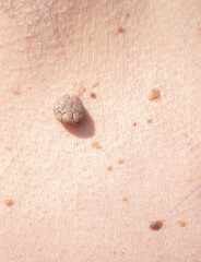 Nevus close-up. Mole on human skin. Irregular birthmark.