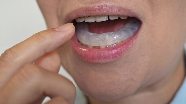 Woman puts dental splint guard in her mouth. TMJ splint disorder treatment. Occlusal splint. Prevent bruxism. Mouth guard for TMJ. Teeth protection. Pain in jaw. Teeth grinding.