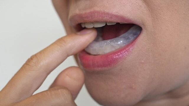 Woman puts dental splint guard in her mouth. TMJ splint disorder treatment. Occlusal splint. Prevent bruxism. Mouth guard for TMJ. Teeth protection. Pain in jaw. Teeth grinding.