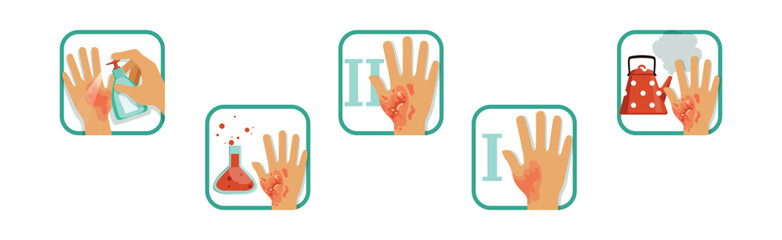 Hand Burn Degree and First Aid Procedure Vector Set