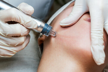 Young woman receiving hydra facial treatment for exfoliation, rejuvenation and hydration of her face skin. Modern facial hydro microdermabrasion peeling beauty procedure. Hydra vacuum cleaner.