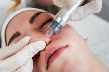 Young woman receiving hydra facial treatment for exfoliation, rejuvenation and hydration of her face skin. Modern facial hydro microdermabrasion peeling beauty procedure. Hydra vacuum cleaner.