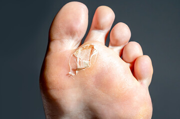 A close-up of a foot with calluses showing the healing process of a blister on the sole,...
