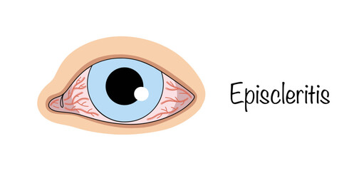 Episcleritis
