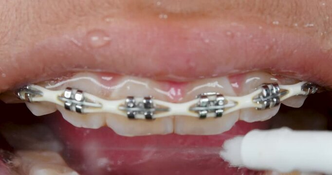 Mouth opening to use water flosser or water pix