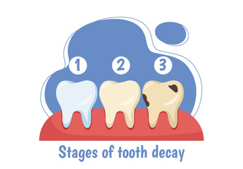 Stages of tooth decay. Medical infographics and educational materials. Cleanliness and hygiene. Diagnosis and treatment. Flat vector illustration isolated on white background