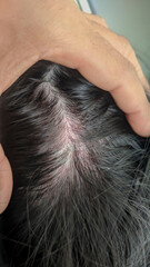 Close up of a child's scalp, with red and irritated skin.