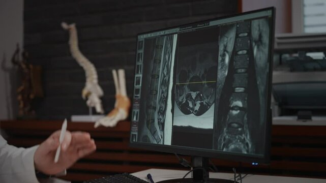 An unrecognizable doctor examines an MRI image on a computer screen. The accuracy of the diagnosis depends on the qualifications of the doctor and the accuracy of the x-ray.