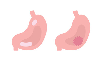 健康な胃と胃潰瘍