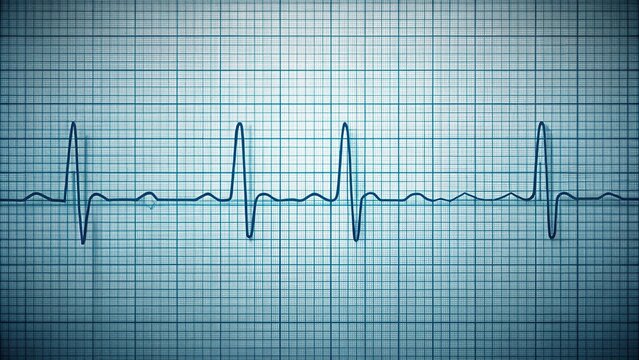 Forced perspective tracing of an electrocardiogram with cardiac arrhythmia