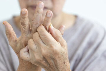 Close up of hands,senior woman suffering from Rheumatoid Arthritis,autoimmune disease,old elderly...