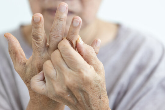 Close up of hands,senior woman suffering from Rheumatoid Arthritis,autoimmune disease,old elderly has pain in her fingers,painful inflammation and stiffness of the joints,chronic progressive disease