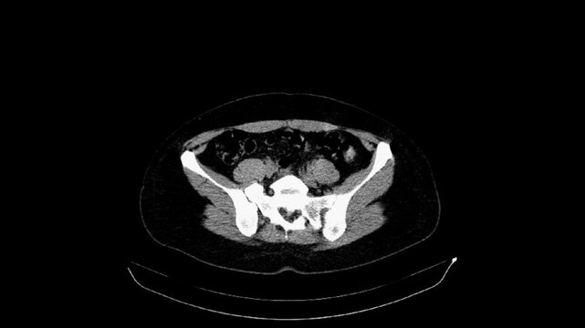 CT of the abdomen and pelvis of a 40-year-old woman. Axial view. Non-contrast. Series description 5.0 B41s