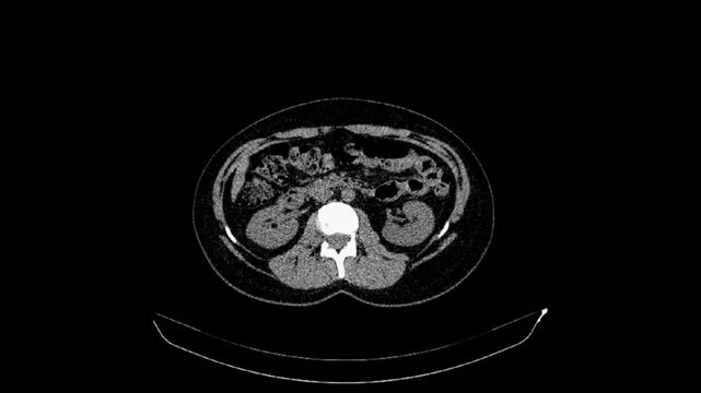 CT of the abdomen and pelvis of a 40-year-old woman. Axial view. Non-contrast. Series description 1.5 B41s