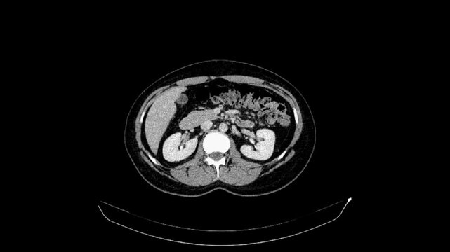 CT of the abdomen and pelvis of a 40-year-old woman. Axial view. Venous phase. Series description 1.5 B41s.