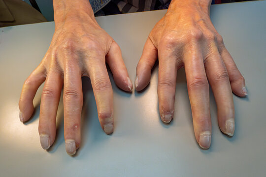 Medical themed: Female patient hands with scleroderma