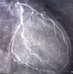 Coronary angiogram of left coronary artery during cardiac catheterization with contrast dye....