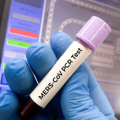 Blood sample for MERS-CoV (Middle East respiratory syndrome coronavirus) test.