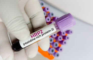 Blood sample for Histidine Rich protein II (HRP2) test, to diagnose Plasmodium falciparum. Malaria...
