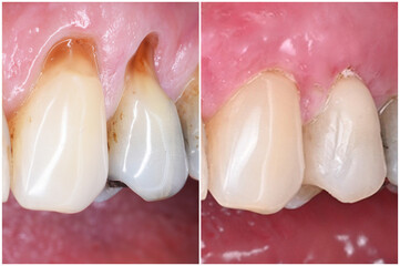 perio surgery and gum disise 