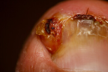 Obraz premium Highly detailed view of a nail with signs of injury or infection, revealing textures and discoloration. Focuses on podiatry or dermatology.