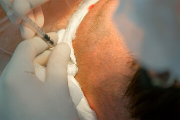 Surgeon in latex gloves making injection of local anesthesia into head of bald patient during hair transplantation procedure. Problem of baldness, treatment of alopecia by hair transplantation.