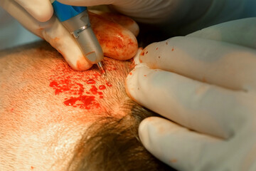 Surgeon cuts out hair grafts from patient head using punch to hair transplant. Problem of baldness of men in middle age, treatment of alopecia by hair transplantation surgery in clinic hospital.