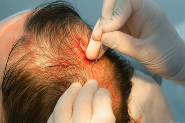 Surgeon punctures head scalp with metal tool to hair transplant operation. Problem of baldness, treatment of alopecia by hair transplantation in clinic hospital. Preparing holes to put hair grafts.