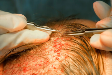 Surgeon transplants hair grafts to head scalp uses tweezers on surgery in clinic. Problem of baldness, treatment of alopecia by hair transplantation in hospital. Operation, cure, hair transplant.