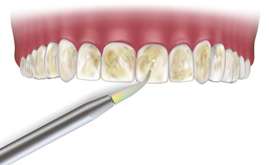 Laser Removal of Dental Calculus. Dental laser. Laser Gum Therapy 