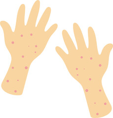 Hand rashes illustration