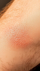 Fototapeta premium Detailed Macro Photography of Granuloma Annulare with Clear Circular Lesions and Skin Characteristics