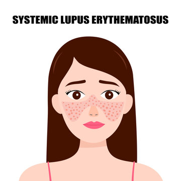 Systemic lupus erythematosus. Young woman with the typical butterfly rash in lupus. SLE. skin disease