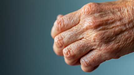 Fototapeta premium Wrist Close-Up Depicting Severe Contact Dermatitis with Red, Itchy Skin, Swollen Texture, and Tiny Blisters Captured in Soft Natural Lighting