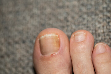 Fungal disease of the woman's toenail.