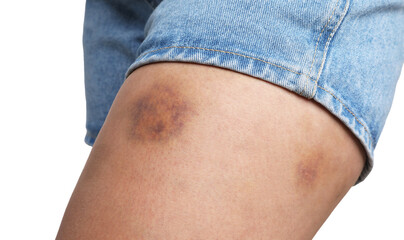 Woman with bruise on leg against white background, closeup