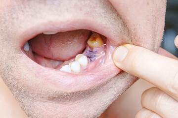 close-up. man showing a sutured socket in the oral cavity after tooth extraction. the work of a dentist surgeon.