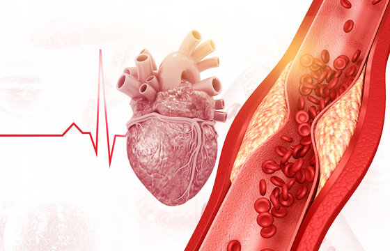 Cholesterol blocked artery with human heart. 3d illustration..