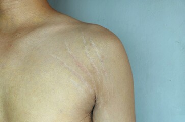 Fototapeta premium stretch marks on armpit skin area