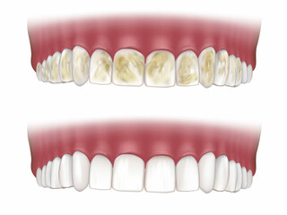 Obraz premium Deep Teeth Cleaning. Before and After. Teeth whitening concept. Debridement dental. Dental plaque tartar
