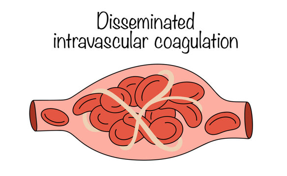 Disseminated intravascular coagulation
