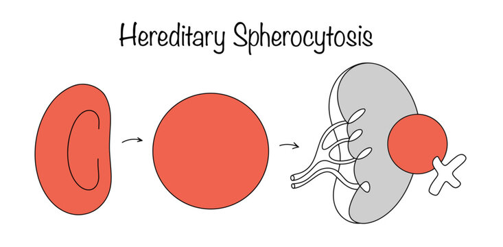 Hereditary Spherocytosis