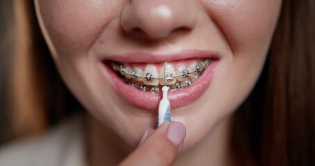 Fototapeta premium Close-up of young woman cleaning dental braces with small brush. Concept of oral hygiene, health care, and orthodontic treatment. Importance of proper braces maintenance and dental care.