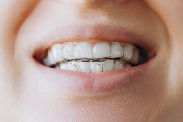 Woman Is Smiling Showing Her Invisible Teeth Aligners For A Straight Smile. Close Up