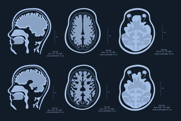 MRI image of a human brain showing all the major manifestations of multiple sclerosis