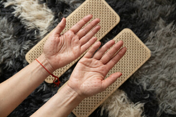 Close up of woman palms after sadhu board. Alternative medicine and yoga concept. High quality photo